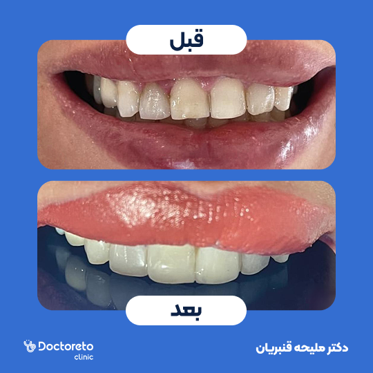 ونیر کامپوزیت (هر واحد)⬅️ دکتر ملیحه قنبریان در شیراز 1