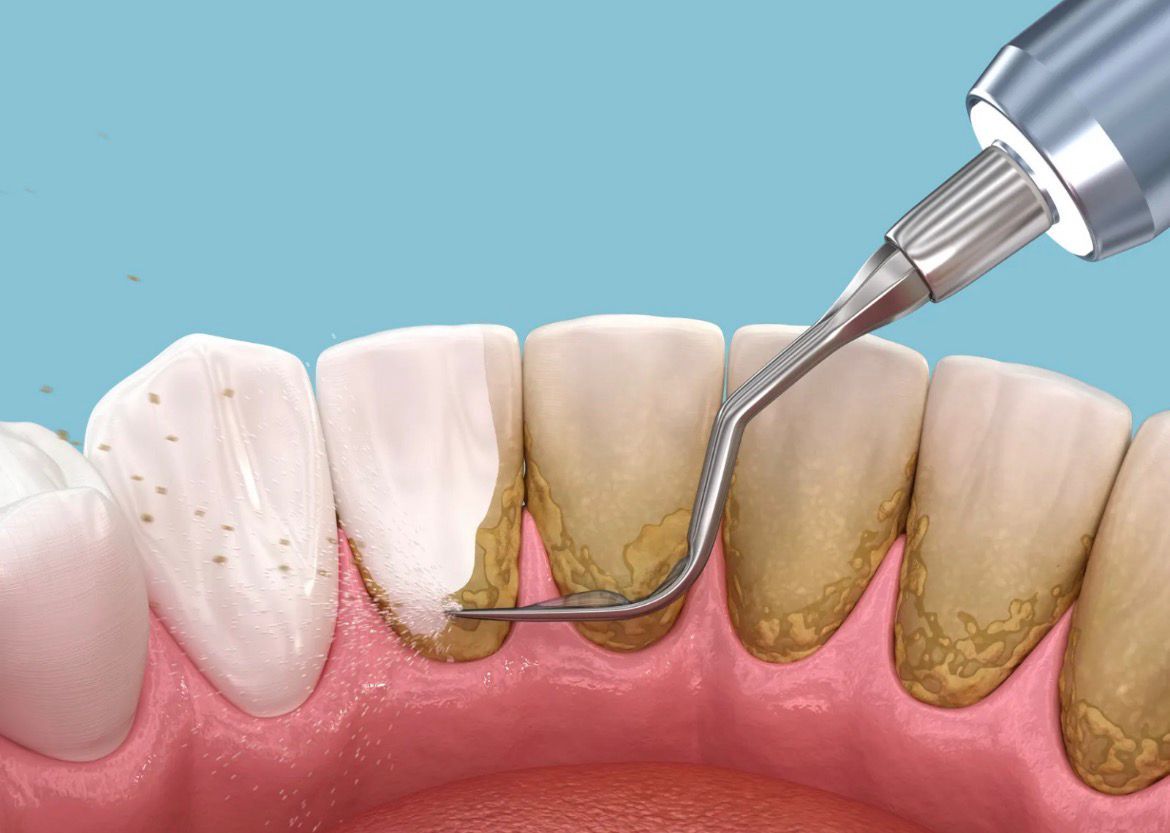جرم گیری کامل دندان‌های دو فک با بروساژ🦷 دکتر سینا دشتی زاده در شیراز 1