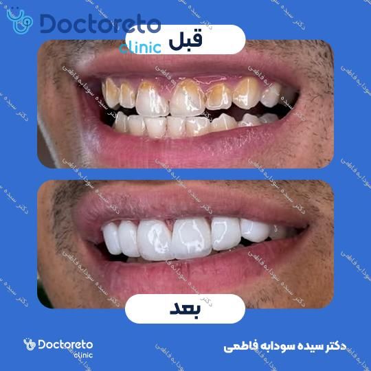 ونیر کامپوزیت (هر واحد)⬅️ دکتر سیده سودابه فاطمی در مشهد 1