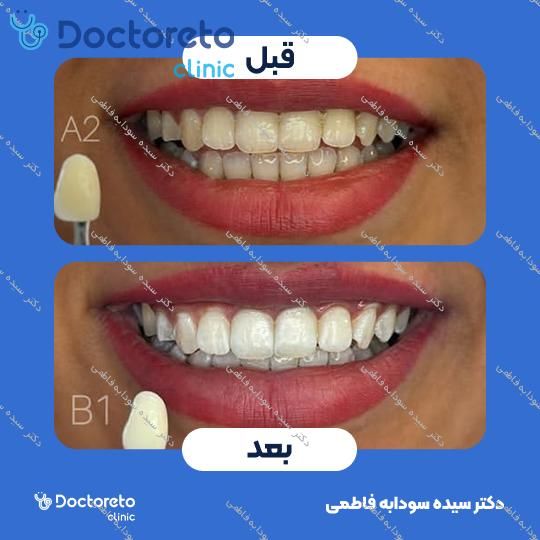 بلیچینگ دندان (سفید کردن دندان) دکتر سیده سودابه فاطمی در مشهد 1