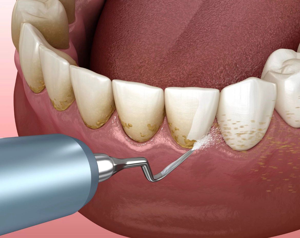 جرم گیری کامل دندان‌های دو فک با بروساژ🦷 دکتر امیر محمدی در تهران 1