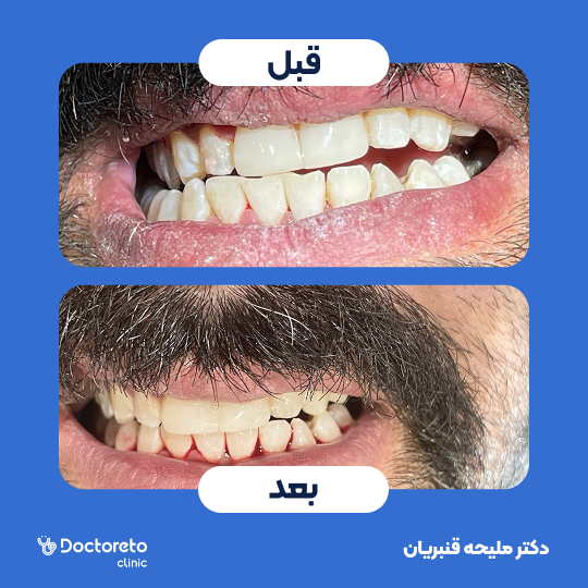 جرم گیری کامل دندان‌های دو فک🦷 دکتر ملیحه قنبریان در شیراز 1