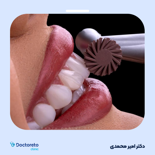 لمینت دندان (هر واحد)⬅️ دکتر امیر محمدی در تهران 1