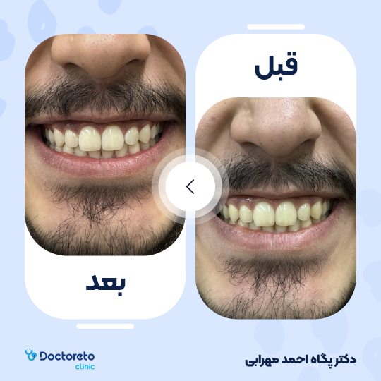 بلیچینگ دندان (سفید کردن دندان) دکتر پگاه احمدمهرابی در تهران 1
