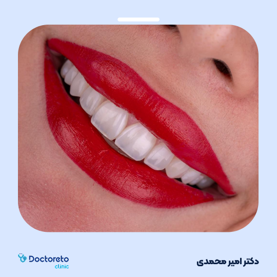 ونیر کامپوزیت دندان (هر واحد)⬅️ دکتر امیر محمدی در تهران 1
