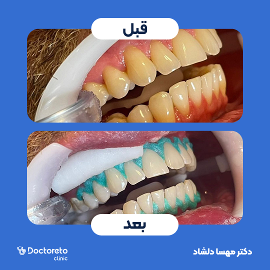 بلیچینگ دندان (سفید کردن دندان) دکتر مهسا دلشاد در کرج 1