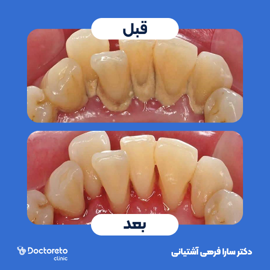 جرم گیری کامل دندان‌های دو فک با بروساژ🦷 دکتر سارا فرهی آشتیانی در تهران 1