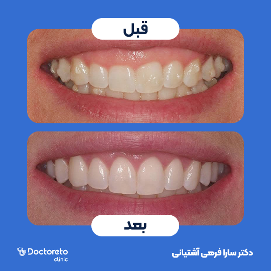 لمینت دندان (هر واحد)⬅️ دکتر سارا فرهی آشتیانی در تهران 1