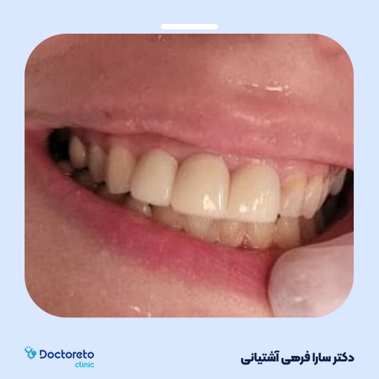 روکش دندان (هر واحد)⬅️ دکتر سارا فرهی آشتیانی در تهران 1