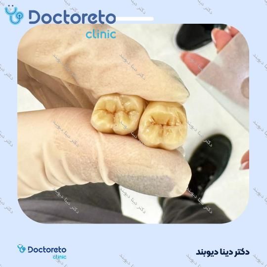 روکش دندان (هر واحد) دکتر دینا دیوبند در تهران 1