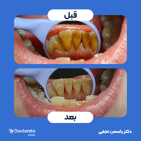 جرم گیری کامل دندان‌های دو فک با بروساژ🦷 دکتر یاسمن نجفی در کرج 1