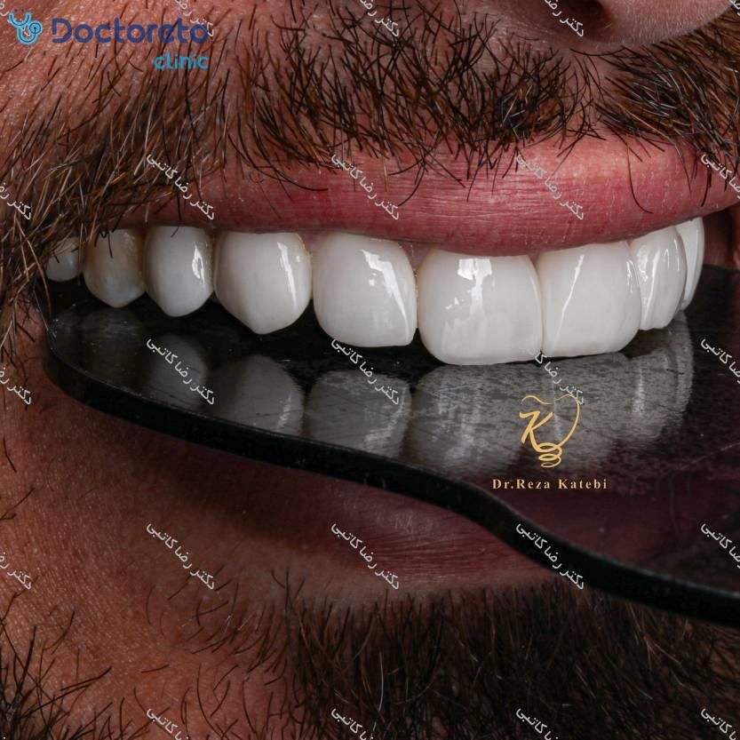 لمینت دندان (هر واحد)⬅️ دکتر رضا کاتبی در شیراز 1