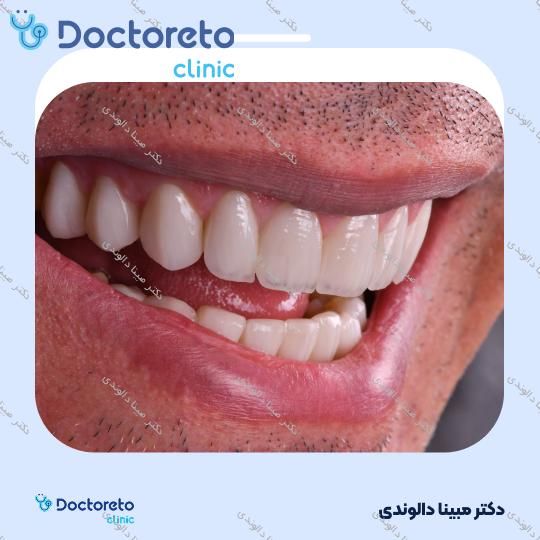 پر کردن دندان⬅️ دکتر مبینا دالوندی در تهران 1