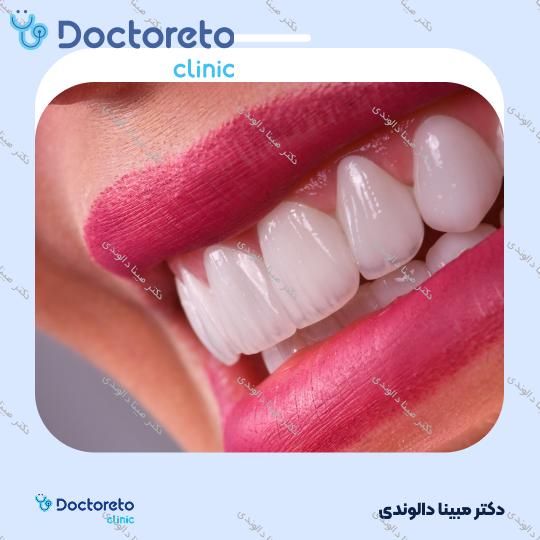 لمینت دندان (هر واحد)⬅️ دکتر مبینا دالوندی در تهران 1