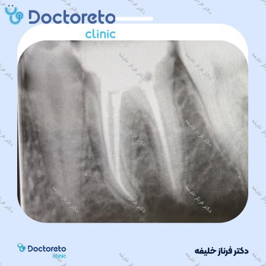 عصب کشی دندان⬅️ دکتر فرناز خلیفه در اصفهان 1