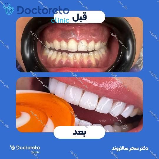 ونیر کامپوزیت (هر واحد)⬅️ دکتر سحر سالاروند در تهران 1