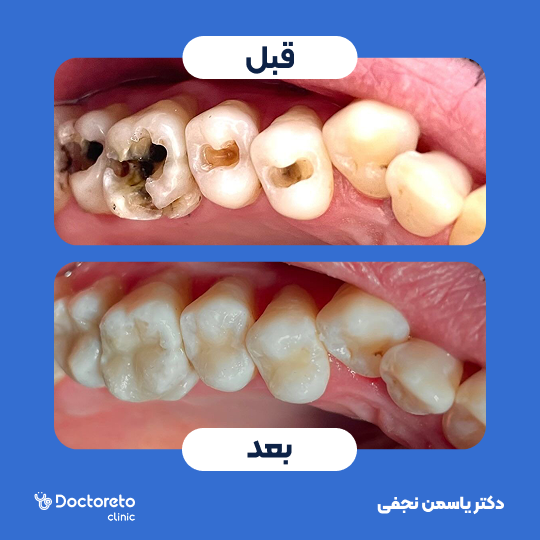 عصب کشی دندان⬅️ دکتر یاسمن نجفی در کرج 1