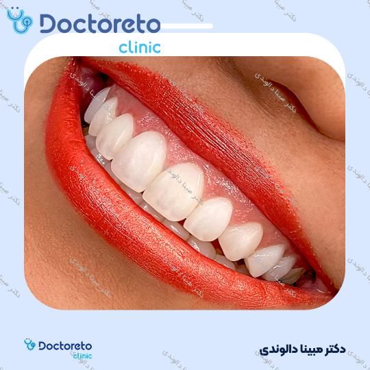 ونیر کامپوزیت (هر واحد)⬅️ دکتر مبینا دالوندی در تهران 1