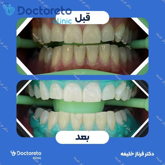 بلیچینگ دندان (سفید کردن دندان) دکتر فرناز خلیفه در اصفهان 1