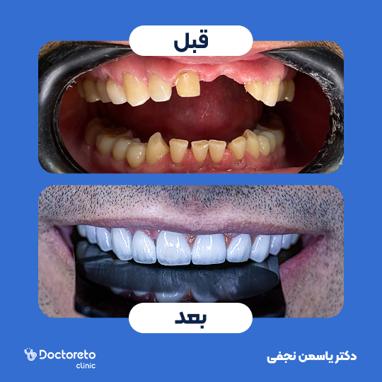 روکش دندان (هر واحد)⬅️ دکتر یاسمن نجفی در کرج 1