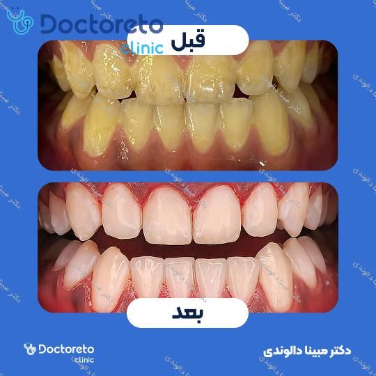 بلیچینگ دندان (سفید کردن دندان) دکتر مبینا دالوندی در تهران 1