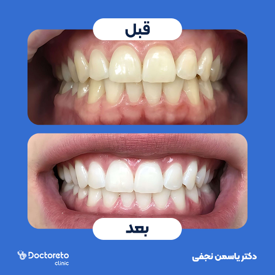 بلیچینگ دندان (سفید کردن دندان) دکتر یاسمن نجفی در کرج 1