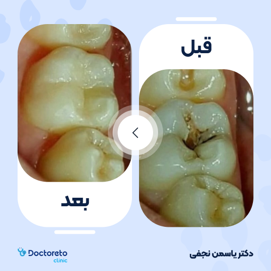 پر کردن دندان⬅️ دکتر یاسمن نجفی در کرج 1