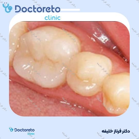 پر کردن دندان⬅️ دکتر فرناز خلیفه در اصفهان 1