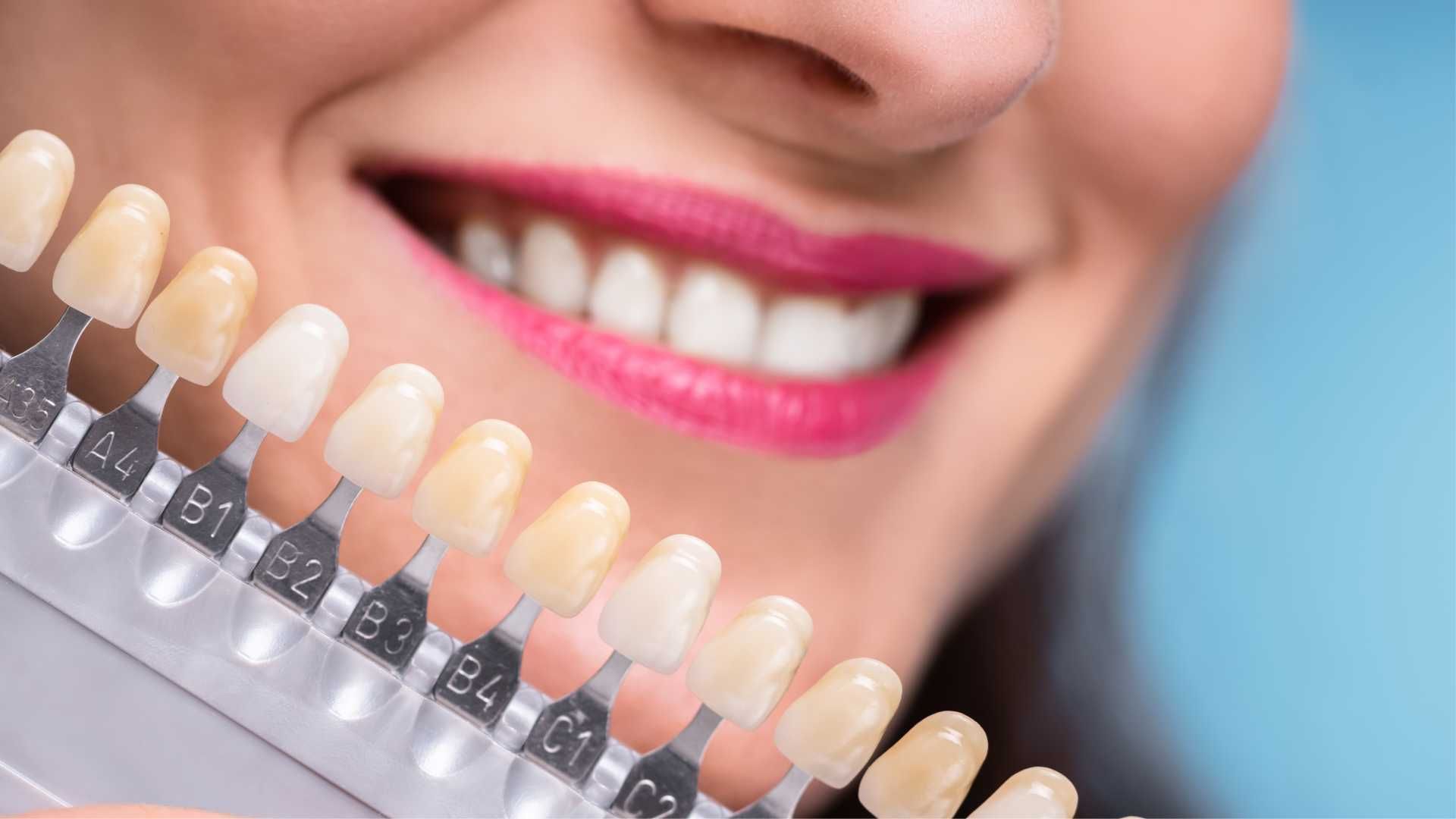 روکش دندان (هر واحد)⬅️ دکتر عاطفه صادقیان جوان در شیراز 1