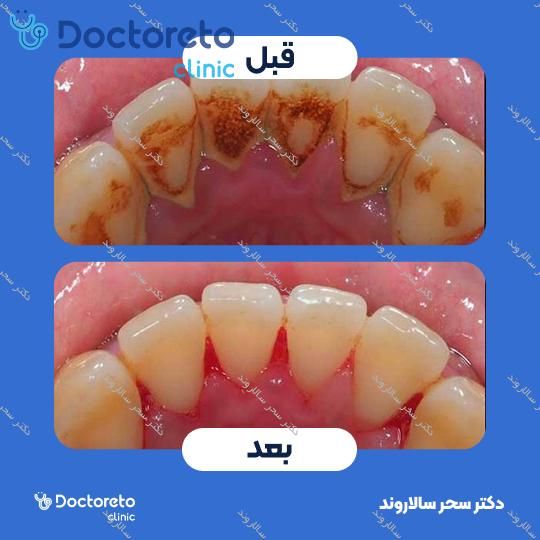 جرم گیری کامل دندان‌های دو فک با بروساژ🦷 دکتر سحر سالاروند در تهران 1