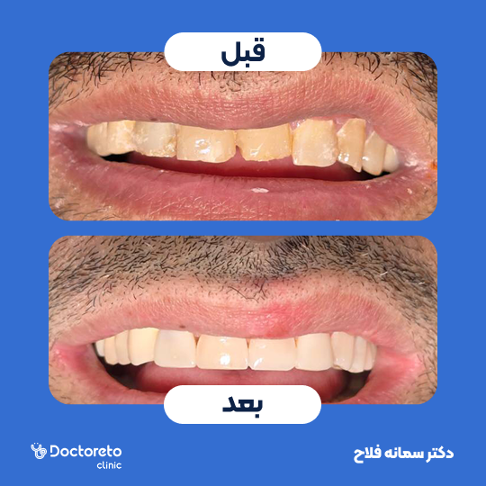 ونیر کامپوزیت (هر واحد)⬅️ دکتر سمانه فلاح در تهران 1