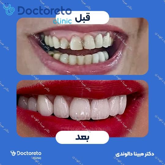 روکش دندان (هر واحد)⬅️ دکتر مبینا دالوندی در تهران 1