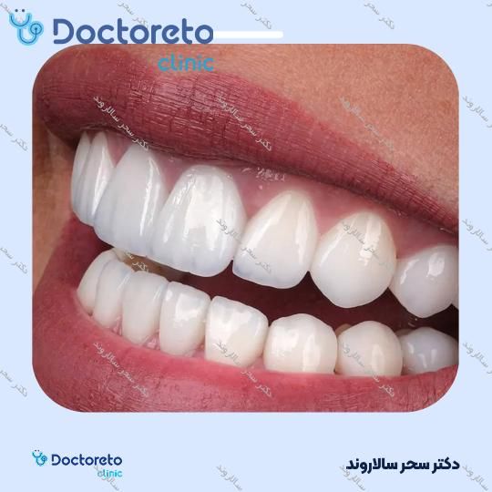 لمینت دندان (هر واحد)⬅️ دکتر سحر سالاروند در تهران 1