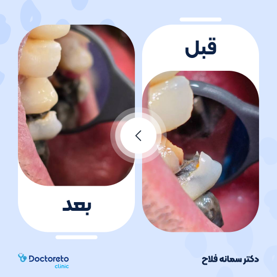 پر کردن دندان⬅️ دکتر سمانه فلاح در تهران 1