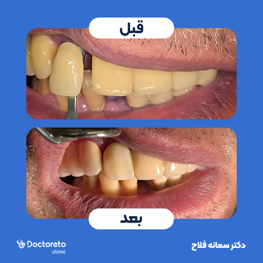 روکش دندان دیجیتال (هر واحد)⬅️ دکتر سمانه فلاح در تهران 1