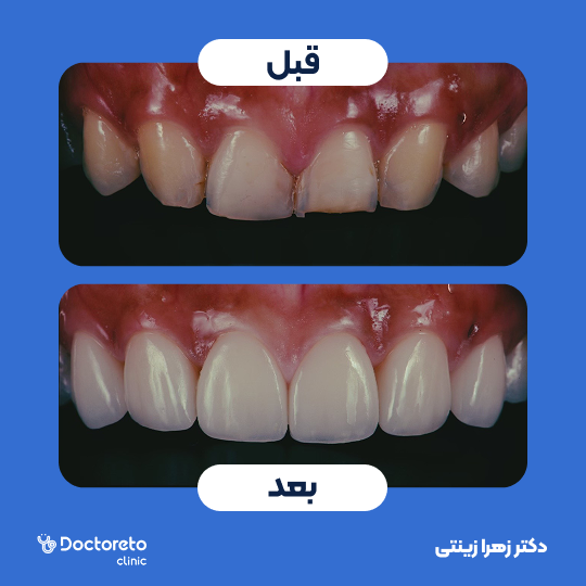 ونیر کامپوزیت (هر واحد)⬅️ دکتر زهرا زینتی در تهران 1