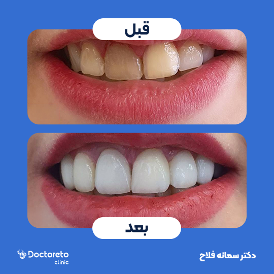 لمینت دندان (هر واحد)⬅️ دکتر سمانه فلاح در تهران 1