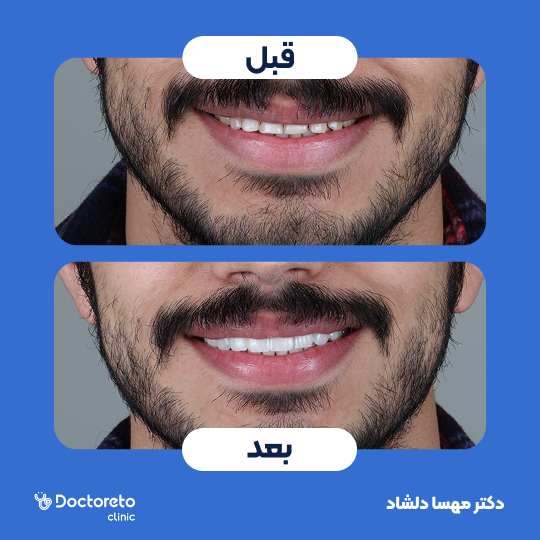 ونیر کامپوزیت (هر واحد)⬅️ دکتر مهسا دلشاد در کرج 1