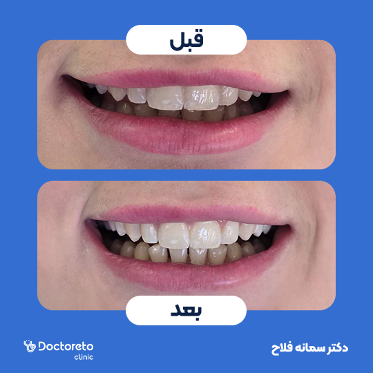 بلیچینگ دندان (سفید کردن دندان) دکتر سمانه فلاح در تهران 1
