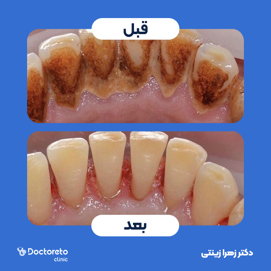 جرم گیری کامل دندان‌های دو فک با بروساژ🦷 دکتر زهرا زینتی در تهران 1