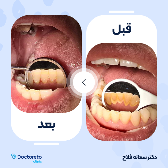 جرم گیری کامل دندان‌های دو فک با بروساژ🦷 دکتر سمانه فلاح در تهران 1