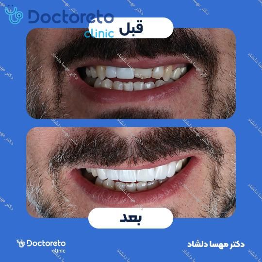 لمینت دندان (هر واحد)⬅️ دکتر مهسا دلشاد در کرج 1