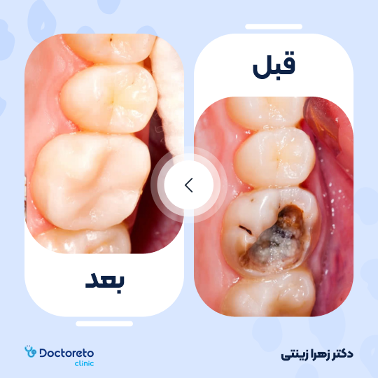 پر کردن دندان⬅️ دکتر زهرا زینتی در تهران 1
