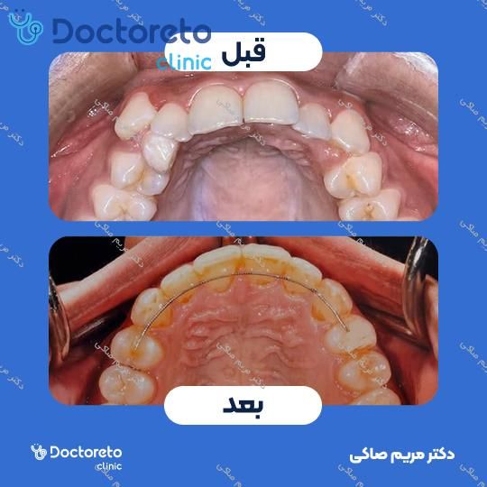 ارتودنسی دندان⬅️ دکتر مریم صاکی در شیراز 1