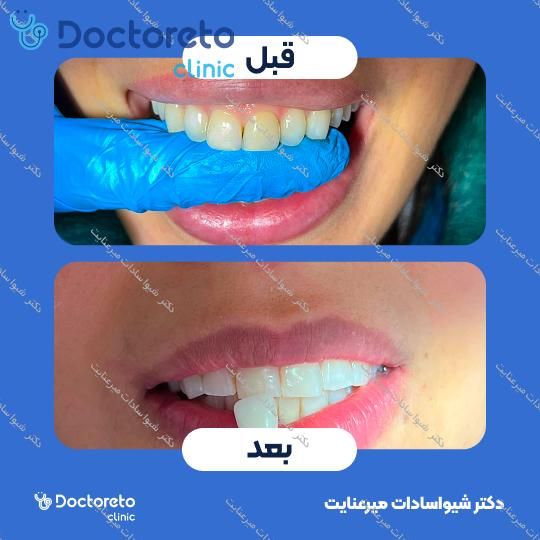 لمینت دندان (هر واحد)⬅️ دکتر شیواسادات میرعنایت در تهران 1