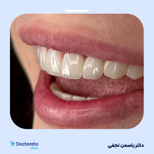ونیر کامپوزیت (هر واحد)⬅️ دکتر یاسمن نجفی در کرج 1