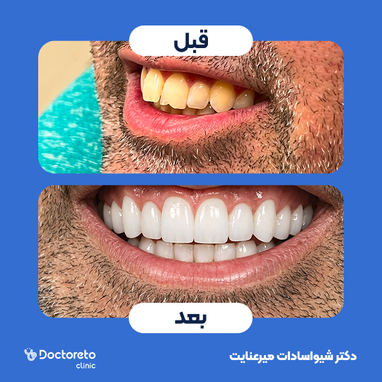 ونیر کامپوزیت (هر واحد)⬅️ دکتر شیواسادات میرعنایت در تهران 1