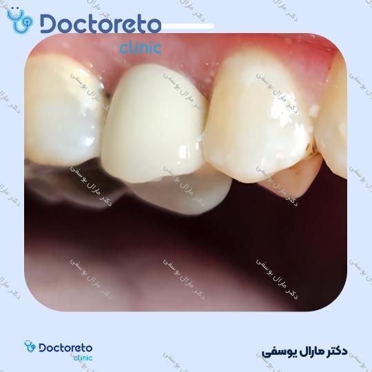 روکش دندان (هر واحد)⬅️ دکتر مارال یوسفی در شیراز 1