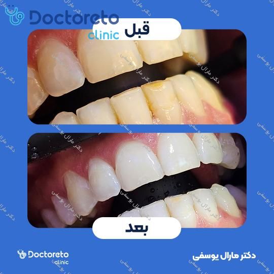 بلیچینگ دندان (سفید کردن دندان) دکتر مارال یوسفی در شیراز 1