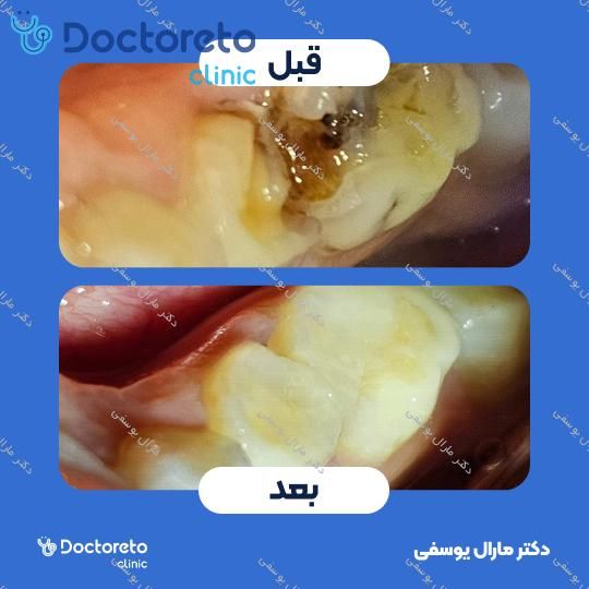 پر کردن دندان⬅️ دکتر مارال یوسفی در شیراز 1